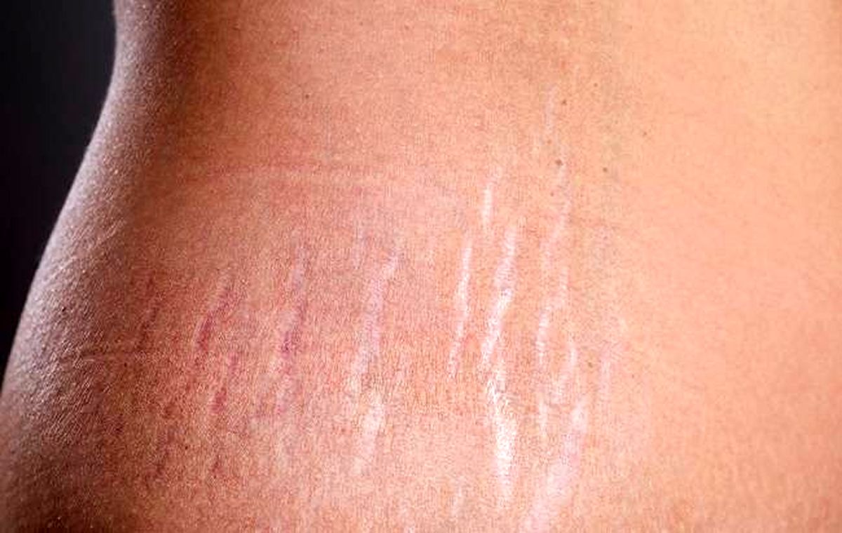 بهترین روش برای از بین بردن سلولیت و ترک های بدن